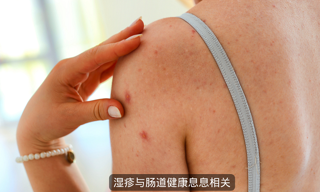 改善濕疹從腸道健康開始 補充益生菌 濕疹少上身