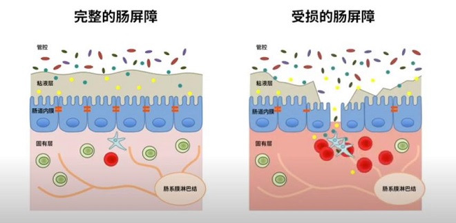 腸漏癥是什么，怎么判斷自己是否有腸漏癥？