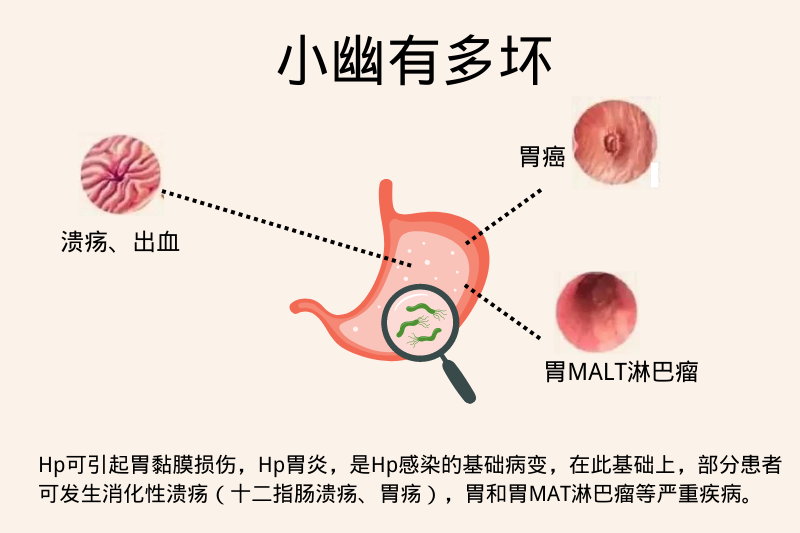 幽門螺旋桿菌小知識：原因、癥狀、治療、預(yù)防